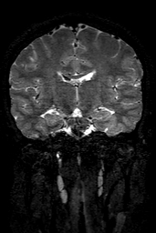 Cerebral arteriovenous malformation at posterior body of corpus callosum (Radiopaedia 74111-84925 Coronal T2 89).jpg