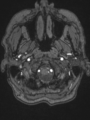 Cerebral arteriovenous malformation with hemorrhage (Radiopaedia 34422-35737 Axial MRA 2).png
