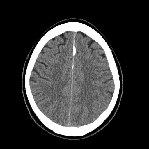 Cerebral arteriovenous malformation with lobar hemorrhage (Radiopaedia 35598-37117 Axial non-contrast 41).jpg