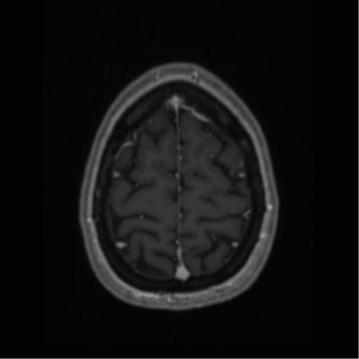 Cerebral cavernoma and development venous anomaly (Radiopaedia 37603-39482 Axial T1 C+ 66).png