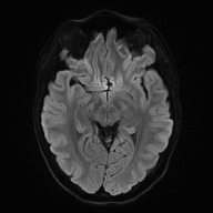 Cerebral cavernous venous malformation (Radiopaedia 70008-80021 Axial DWI 44).jpg