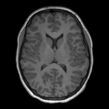 Cerebral cavernous venous malformation (Radiopaedia 70008-80021 Axial T1 42).jpg