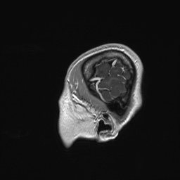 Cerebral cavernous venous malformation (Radiopaedia 70008-80021 Sagittal T1 C+ 4).jpg
