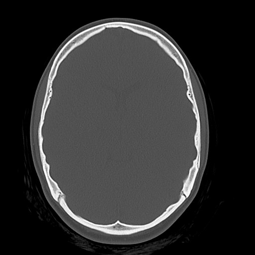 Cerebral cavernous venous malformation (Radiopaedia 70008-80022 Axial bone window 22).jpg