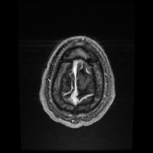 Cerebral cavernous venous malformation (Zabramski type II) (Radiopaedia 85511-101198 Axial T1 C+ fat sat 13).jpg