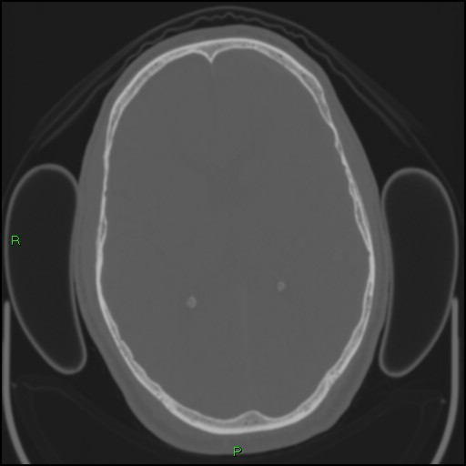 Cerebral contusions (Radiopaedia 33868-35039 Axial bone window 113).jpg