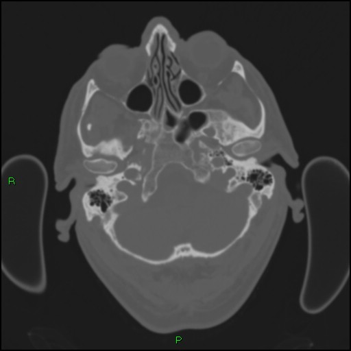 Cerebral contusions (Radiopaedia 33868-35039 Axial bone window 28).jpg
