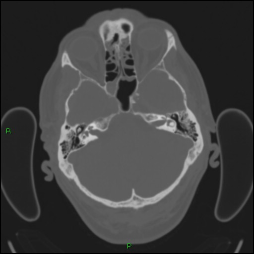 Cerebral contusions (Radiopaedia 33868-35039 Axial bone window 47).jpg