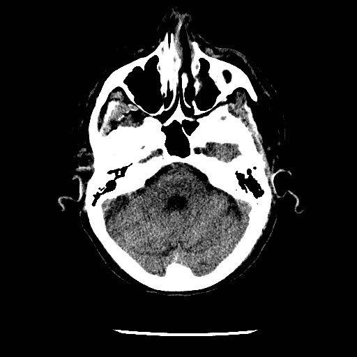 Cerebral edema (evolution in time) (Radiopaedia 19418-19441 non-contrast 28).jpg