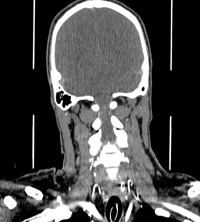 Cerebral edema in an overdose patient (Radiopaedia 72005-82539 B 121).jpg