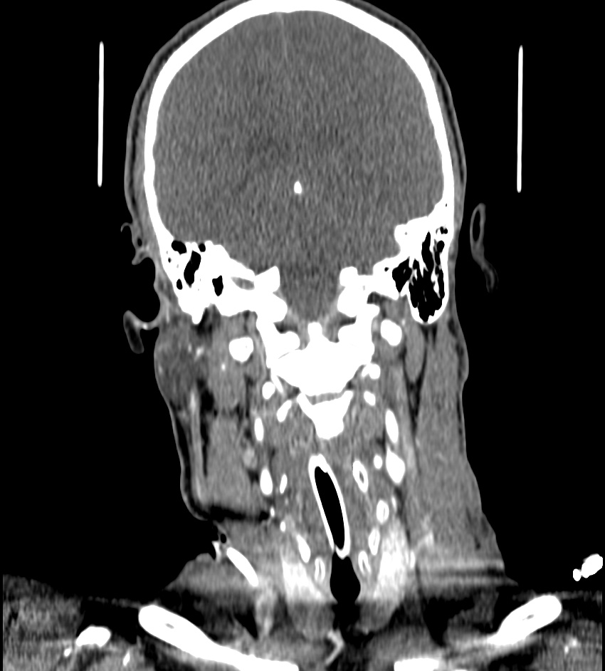 Cerebral edema in an overdose patient (Radiopaedia 72005-82539 B 85).jpg