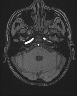 File:Cerebral embolic infarcts (embolic shower) (Radiopaedia 72391-82921 Axial MRA 25).jpg