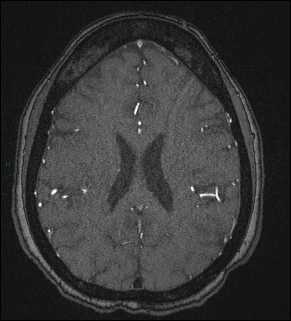 Cerebral fat embolism (Radiopaedia 35022-36525 Axial TOF 133).jpg