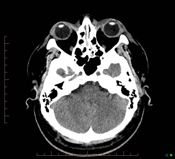 Cerebral fat embolism (Radiopaedia 85521-101224 Axial non-contrast 12).jpg