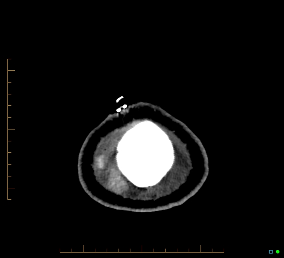 Cerebral fat embolism (Radiopaedia 85521-101224 Axial non-contrast 52).jpg