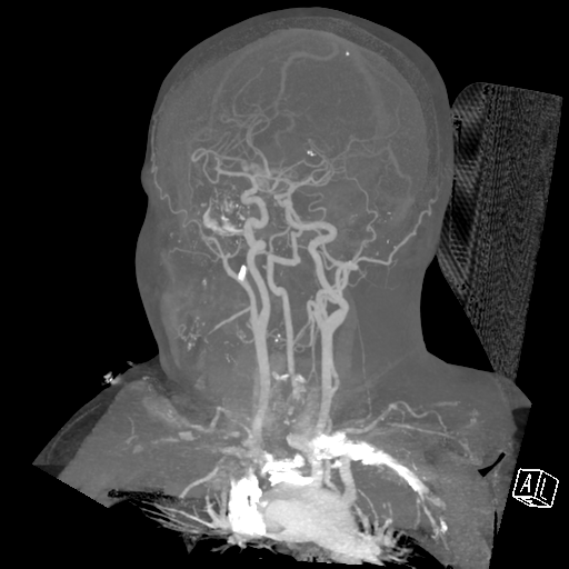 File:Cerebral hemorrhage secondary to arteriovenous malformation (Radiopaedia 33497-34571 A 16).png