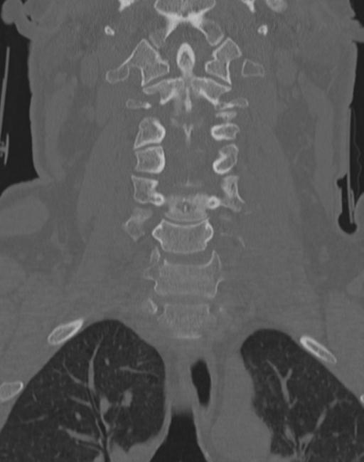 Cerebral hemorrhagic contusions and cervical spine fractures (Radiopaedia 32865-33841 Coronal bone window 30).jpg