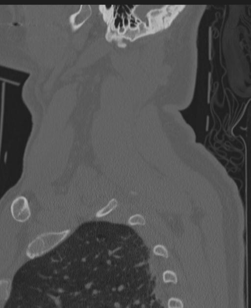 Cerebral hemorrhagic contusions and cervical spine fractures (Radiopaedia 32865-33841 Sagittal bone window 87).jpg