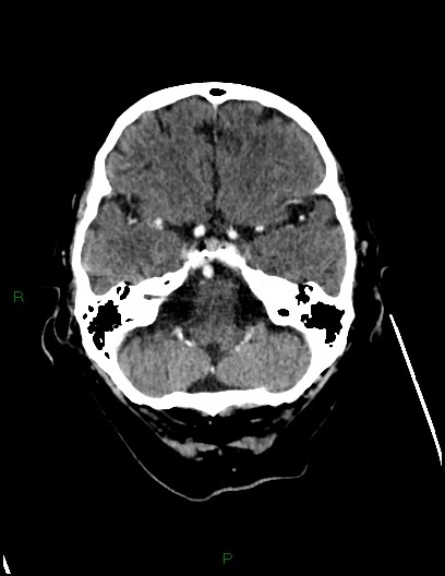 Cerebral metastases - ependymal and parenchymal (Radiopaedia 79877-93131 Axial C+ delayed 19).jpg