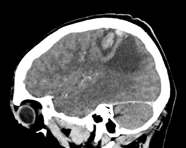 Cerebral metastases - testicular choriocarcinoma (Radiopaedia 84486-99855 F 17).jpg