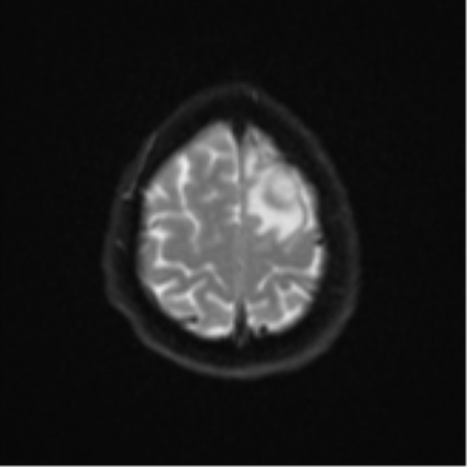 File:Cerebral metastases mimicking abscesses (Radiopaedia 45841-50131 Axial DWI 25).png