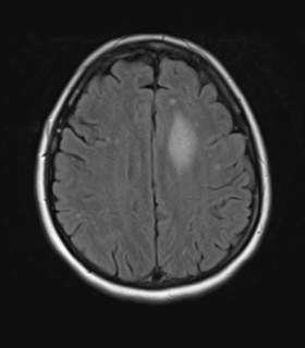 File:Cerebral metastases mimicking abscesses (Radiopaedia 45841-50131 Axial FLAIR 20).png