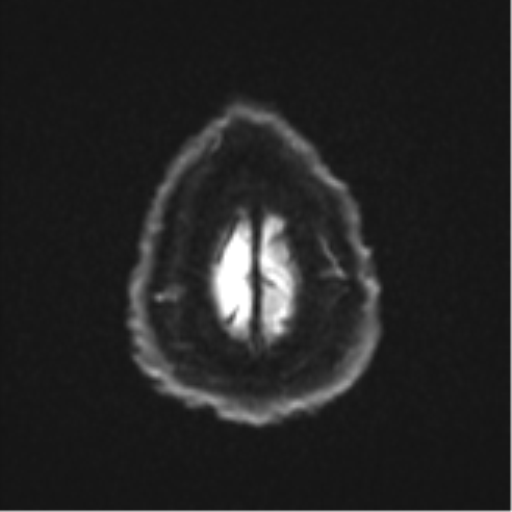 Cerebral metastases mimicking multifocal glioblastoma (Radiopaedia 50843-56353 Axial DWI 26).png