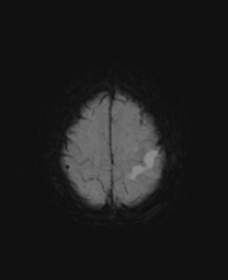 File:Cerebral metastasis (Radiopaedia 46744-51248 Axial SWI 24).png
