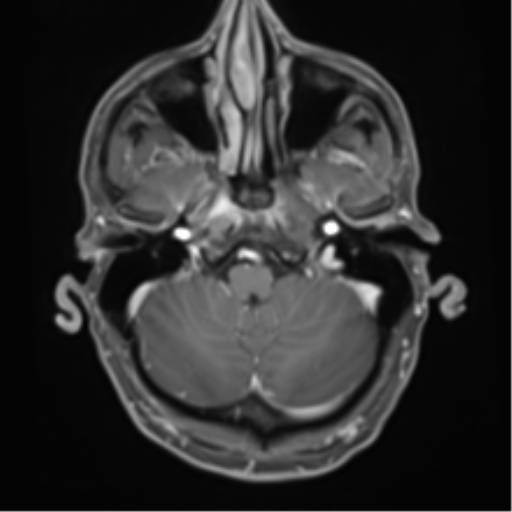 Cerebral metastasis - melanoma (Radiopaedia 54718-60954 Axial T1 C+ fat sat 11).png