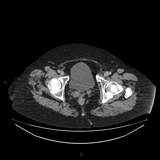 File:Cerebral metastasis from renal cell carcinoma (Radiopaedia 82306-96378 A 184).jpg