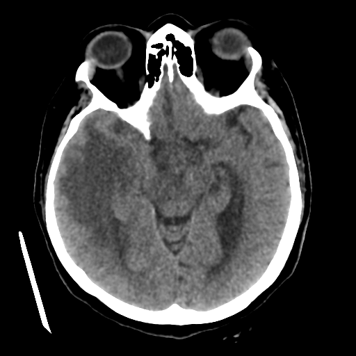 Cerebral metastasis to basal ganglia (Radiopaedia 81568-95412 Axial non-contrast 28).png