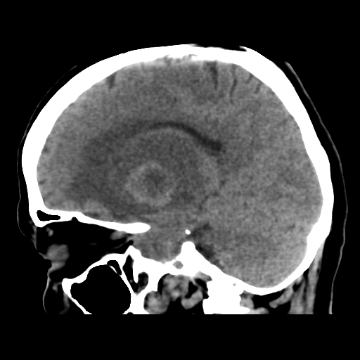 Cerebral metastasis to basal ganglia (Radiopaedia 81568-95412 E 26).png