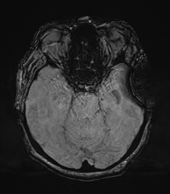 Cerebral metastasis to basal ganglia (Radiopaedia 81568-95413 Axial SWI 28).png