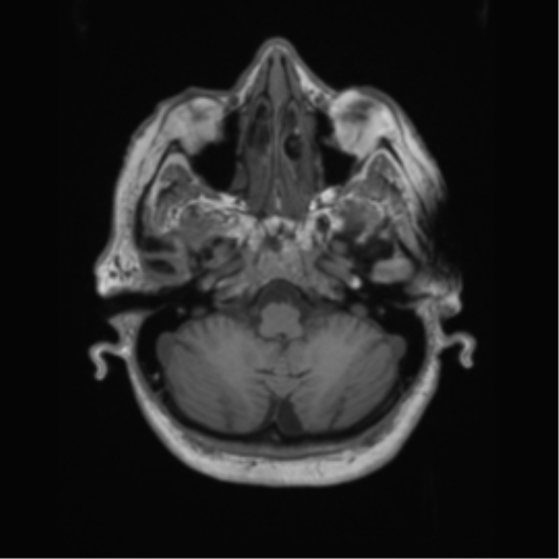 Cerebral metastasis to basal ganglia (Radiopaedia 81568-95413 Axial T1 12).png