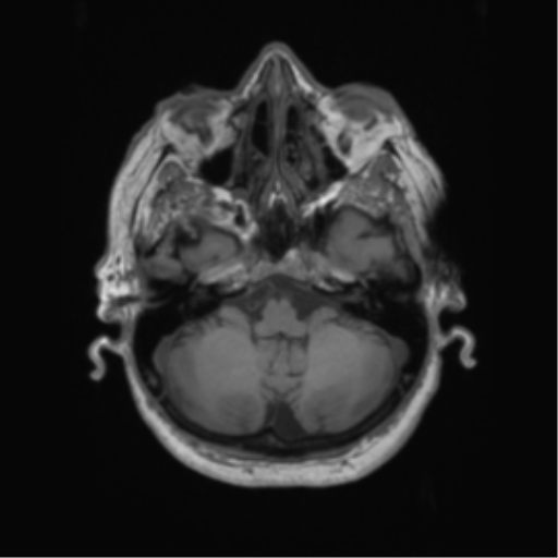 Cerebral metastasis to basal ganglia (Radiopaedia 81568-95413 Axial T1 14).png