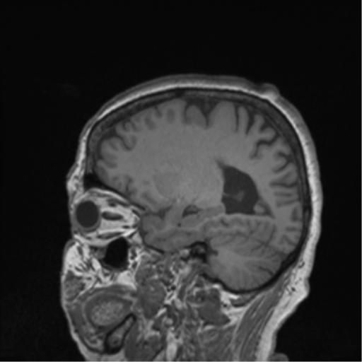 Cerebral metastasis to basal ganglia (Radiopaedia 81568-95413 Sagittal T1 22).png