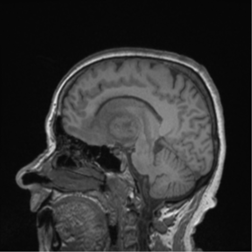 Cerebral metastasis to basal ganglia (Radiopaedia 81568-95413 Sagittal T1 42).png