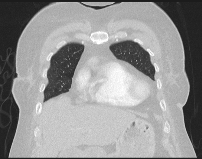 Cerebral metastasis to basal ganglia (Radiopaedia 81568-95414 Coronal lung window 23).png