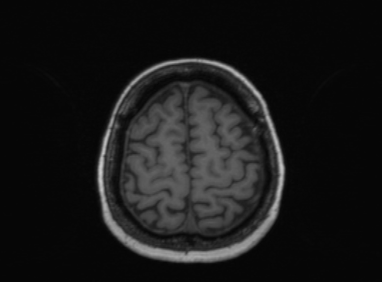 Cerebral ring enhancing lesions - cerebral metastases (Radiopaedia 44922-48817 Axial T1 134).jpg