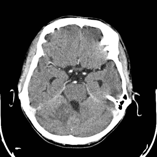File:Cerebral toxoplasmosis (Radiopaedia 43956-47460 Axial C+ delayed 10).jpg
