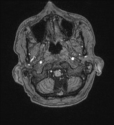 File:Cerebral toxoplasmosis (Radiopaedia 43956-47461 Axial T1 3).jpg