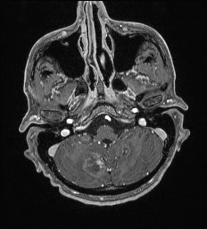 Cerebral toxoplasmosis (Radiopaedia 43956-47461 Axial T1 C+ 10).jpg