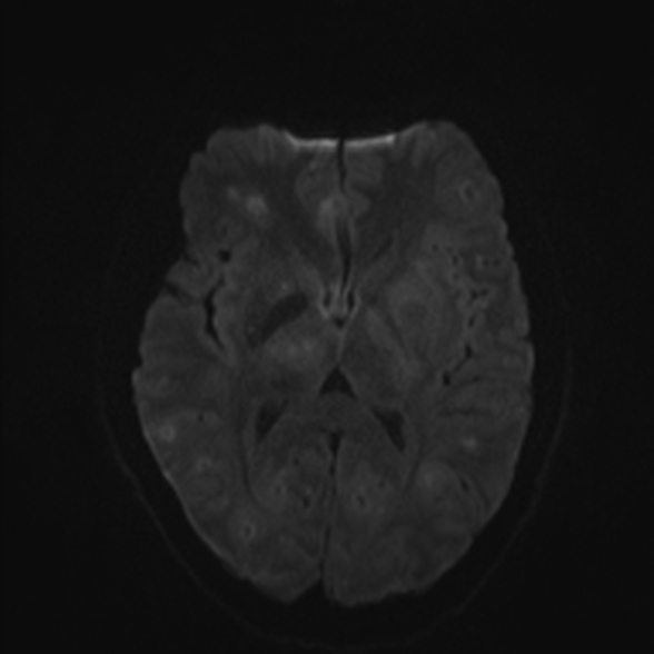 Cerebral toxoplasmosis (Radiopaedia 53993-60132 Axial DWI 41).jpg