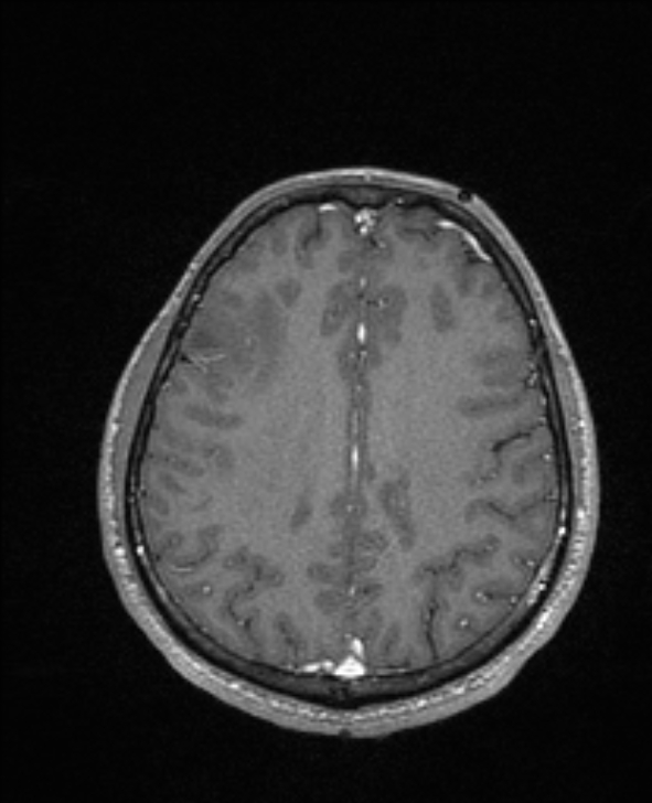 Cerebral toxoplasmosis (Radiopaedia 85779-101597 Axial T1 C+ 116).jpg