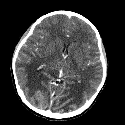 Cerebral tuberculosis with dural sinus invasion (Radiopaedia 60353-68019 Axial C+ delayed 31).jpg