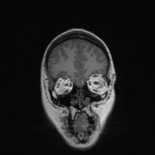 Cerebral tuberculosis with dural sinus invasion (Radiopaedia 60353-68090 Coronal T1 44).jpg