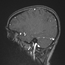 Cerebral venous infarction - hemorrhagic (Radiopaedia 81625-95505 Sagittal MRV 55).jpg