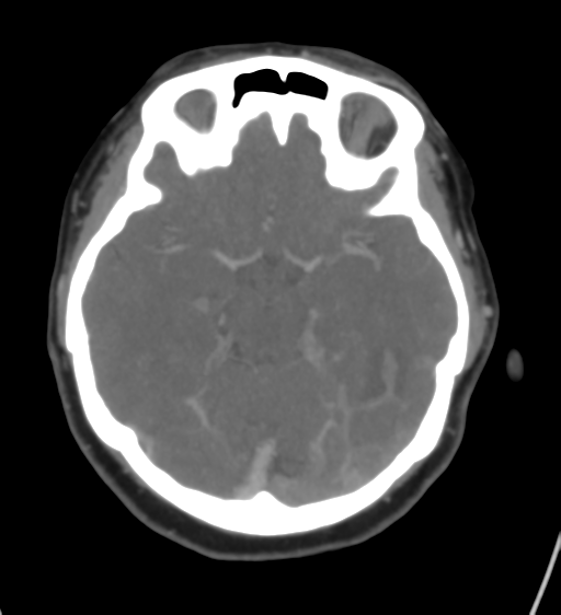 Cerebral venous infarction due to transverse sinus thrombosis (Radiopaedia 34688-36120 Axial CT venogram 21).png