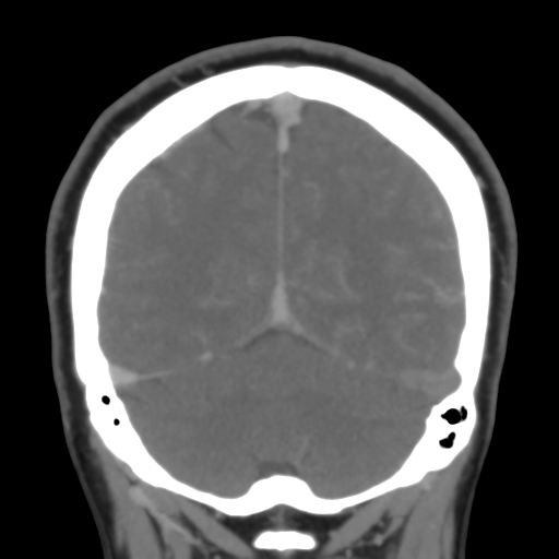 File:Cerebral venous infarction due to transverse sinus thrombosis (Radiopaedia 34688-36120 Coronal 47).png