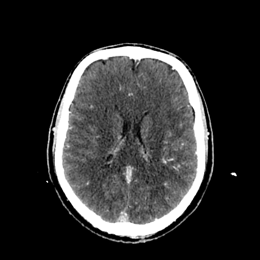 File:Cerebral venous thrombosis (CVT) (Radiopaedia 77524-89685 Axial with contrast 23).jpg